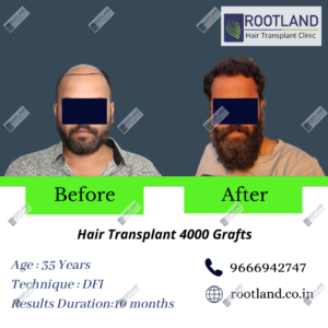 Abhilash-before-after-300x300 4