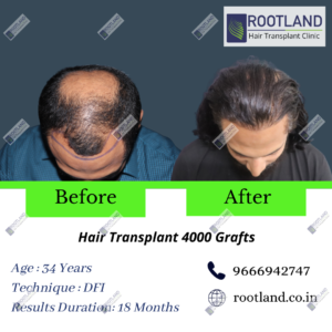Shoab-Khan-before-after-1-1-300x300 2
