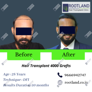 phani-before-after-300x300 3