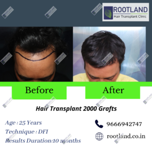 rambabu-before-after-300x300 1